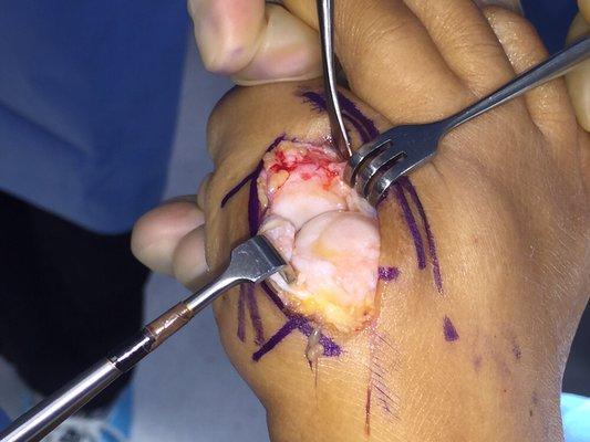 Arthritis in great toe joint. Aka hallux limitus.  Performing cheilectomy procedure.