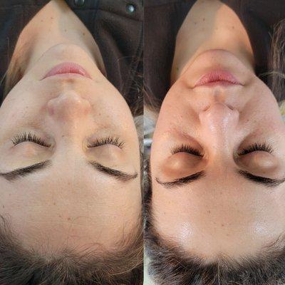 Before and after dermafile