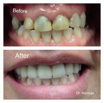 Combination of crowns , bridges and veneers