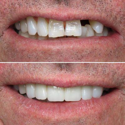 Restorations to replace a missing tooth and enhance the patient's smile done by Dr. Rob