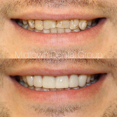 Old broken down bonding and discolored teeth brought this patient to our office seek a better smile!- Dr. Michael Bruno