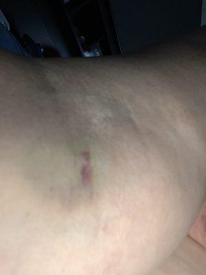 Bruise and hematoma