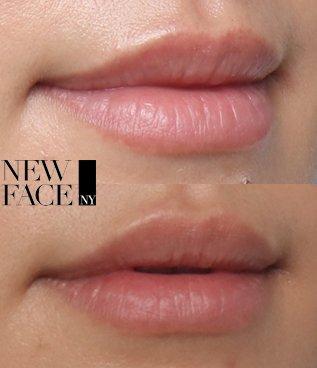 Before and after lip fillers