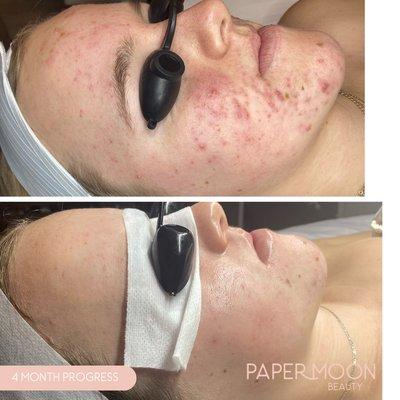 Face Reality Acne Bootcamp 4 month progress