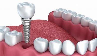 Implant consultation