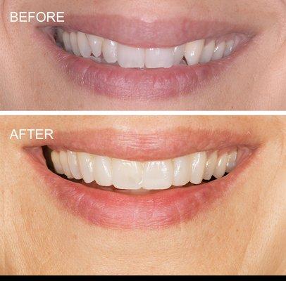 Smile design preview of how porcelain veneers can make crooked front teeth straight.