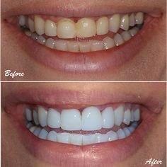 Before and After teeth whitening at Aurora Organic Spray Tans