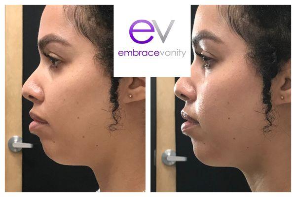 Restylane Lyft was used to augment this client's chin to improve the appearance of her profile.