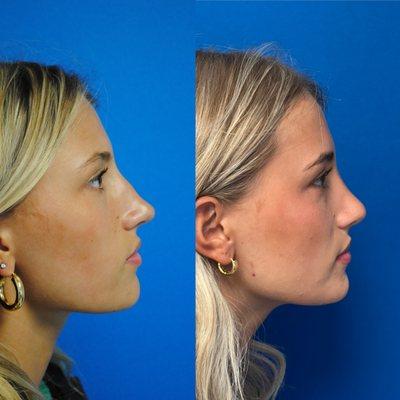 Rhinoplasty before and
 After.  #inosenoses