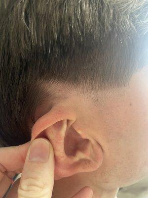 Bald spot from shaving around the ear