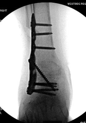 Ankle fusion on a pt with post-traumatic arthritis...