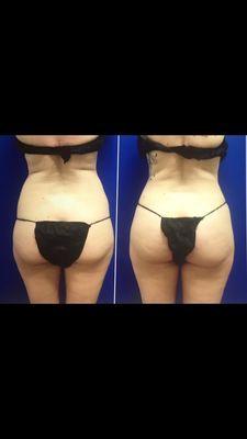 Liposuction of the torso