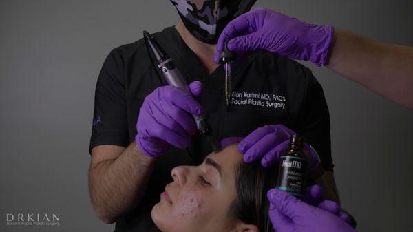 Microneedling with HealMD to treat acne, performed by Dr. Kian at Rejuva Medical Aesthetics.