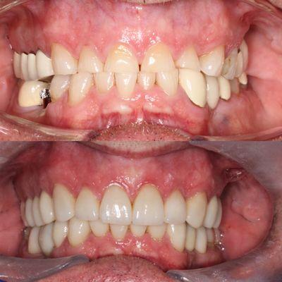 Full mouth rehabilitation before and after