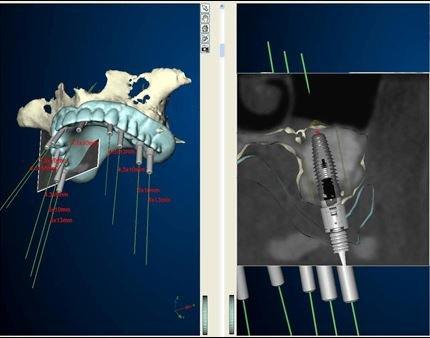 Computer Guided Surgery benefits the patient being that there is less post operative discomfort, less swelling and less bruising.