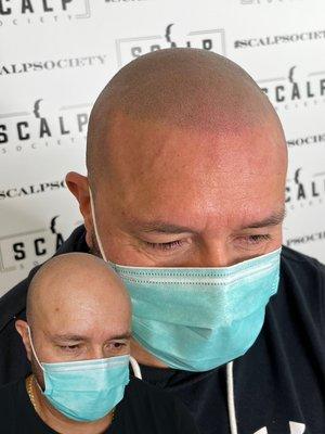 Scalp micropigmentation treatment