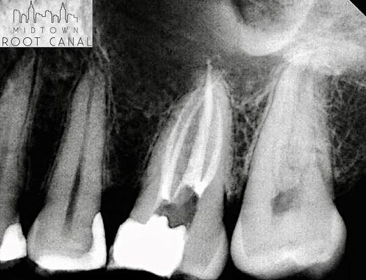 #14 Root Canal treatment. 4 Canals. Excellent long term prognosis! Tooth saved :)