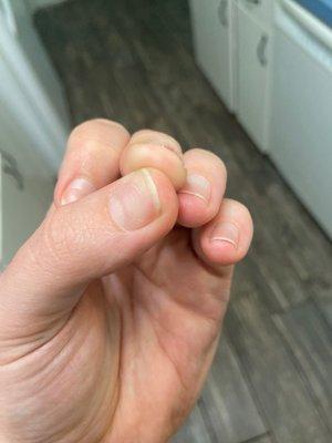 Fungal infection under nail