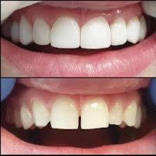 Crystalline, Porcelain veneers and crowns for your optimum celebrity smile