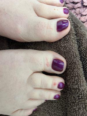 Scratch marks on toes from nail tech from her gloved nails.