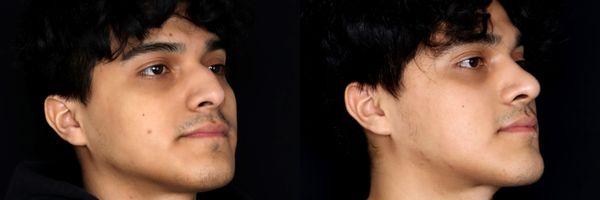 20 yo M before and 3 months after septorhinoplasty