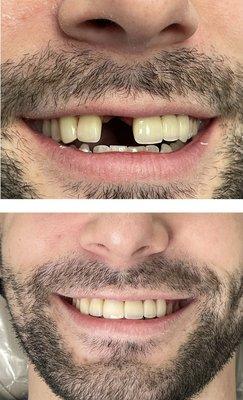 Replacing a missing tooth with an implant and crown