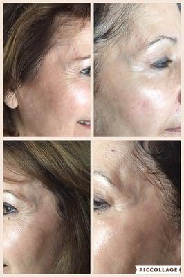 Before and after her first treatment. Ageless Beauty using LeMieux serums and ultrasonic skin scrubber and ultra sound technology.