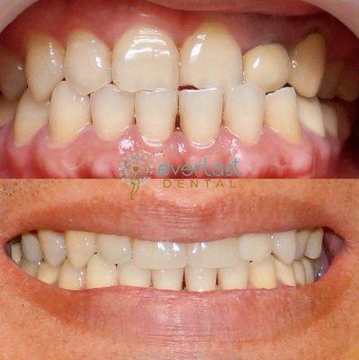 COSMETIC DENTISTRY AND SMILE TRANSFORMATION is our Passion.
 Ceramic Crowns and Veneers can be used to restore chipped and uneven teeth.