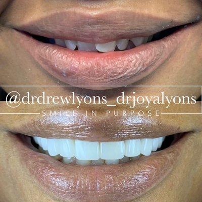 11 porcelain veneers were used to widen and brighten this smile.