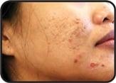 Pre Acne Scarring treatment