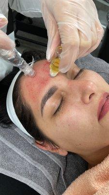 Micro needling with PRP