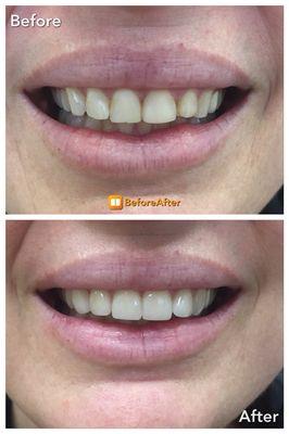 Before and After Upper Veneers