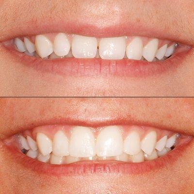 Dr. Shore bonded the spaces between this patient's teeth with tooth colored filling material