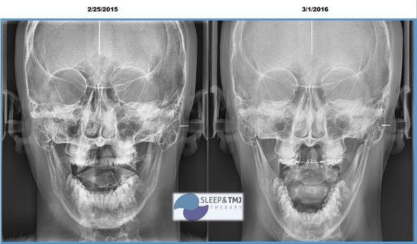 Before: limited opening and headaches. After: healthy range of motion and feeling better!