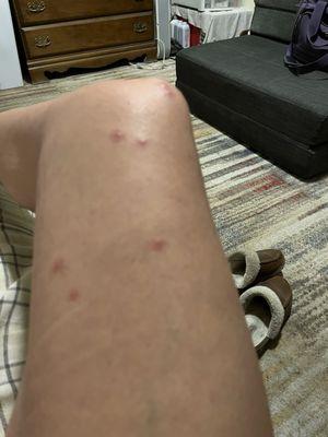 Bed bug bites!