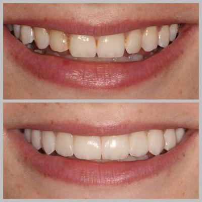 10 Porcelain No-Prep Veneers Before & After.
No Alterations or drilling to natural teeth