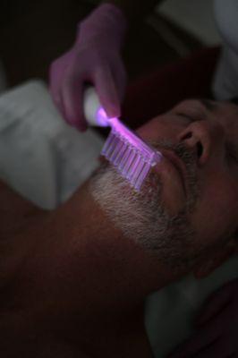 High Frequency Beard Facial