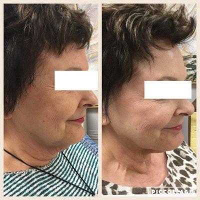 Kybella for under the chin by Renee R