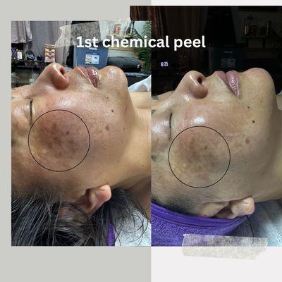 Chemical Peels results