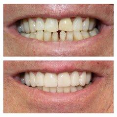 Before and After at NÜVA Smile | Clifton, NJ