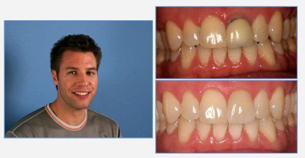 Paul - Crown replacement and teeth whitening!