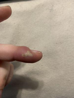 Finger infection from unsanitary nail salon