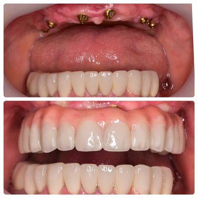 All on 4s. Dentures over implants.