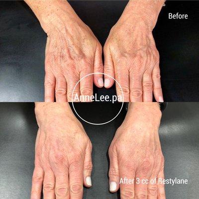 Hand rejuvenation with Restylane.