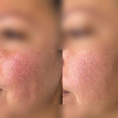 IPL rosacea and vascular