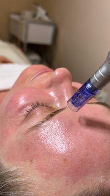 Microneedling!!!