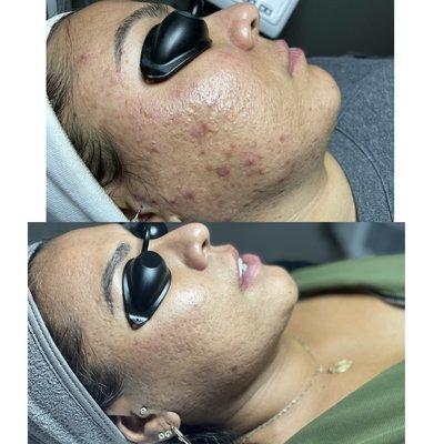 Before and After. Acne treatments