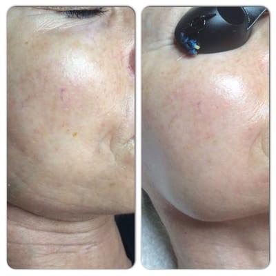 Before and after FSD microphone facial therapy