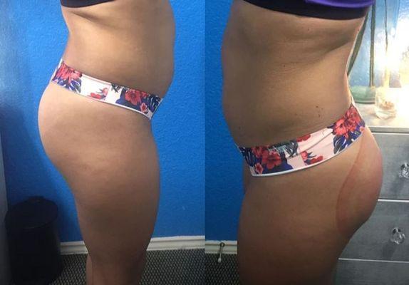 Butt lifting enhancement treatment