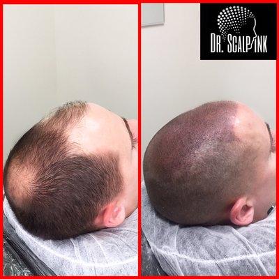 Great transformation of scalp micro pigmentation